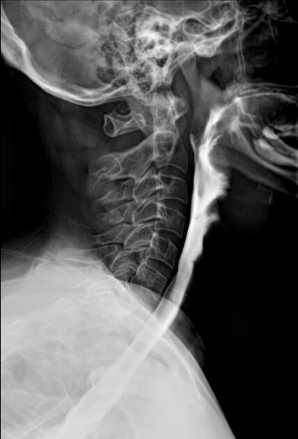 Phẫu thuật cắt thực quản (Esophagectomy)