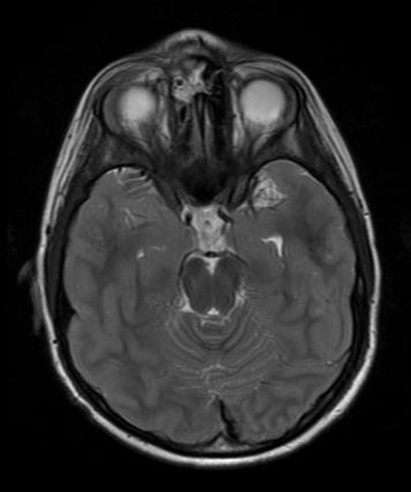 U phồng Pott (Pott puffy tumor- Biến chứng viêm mũi xoang)