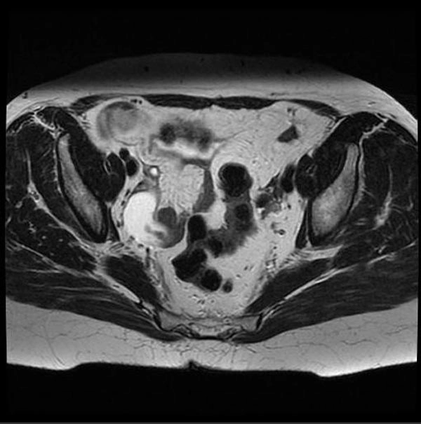 Ung thư vòi trứng nguyên phát (Primary fallopian tube carcinoma)