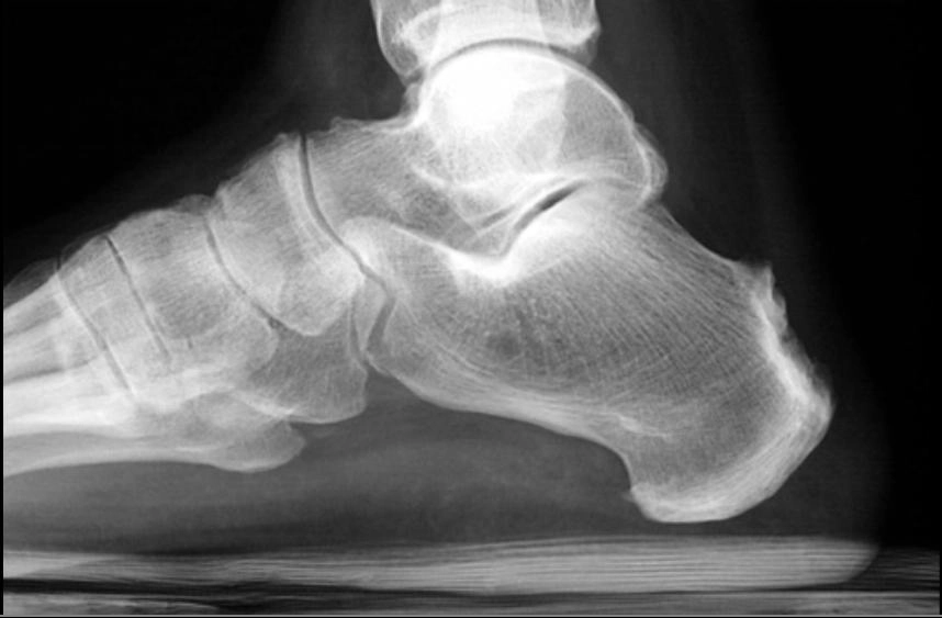 Viêm khớp phản ứng (Reactive arthritis)