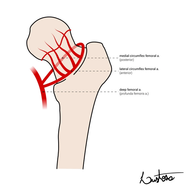 Hoại tử vô mạch chỏm xương đùi (Osteonecrosis of the femoral head)