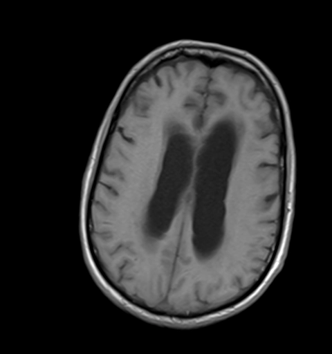 Phù quanh não thất / Phù mô kẽ (Transependymal Edema)
