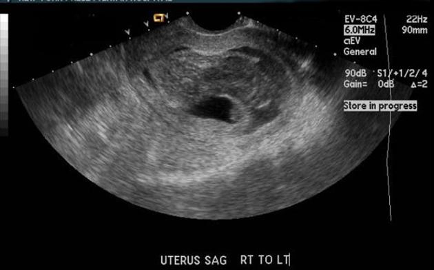 Tụ máu dưới màng nuôi (Tụ máu quanh túi thai)