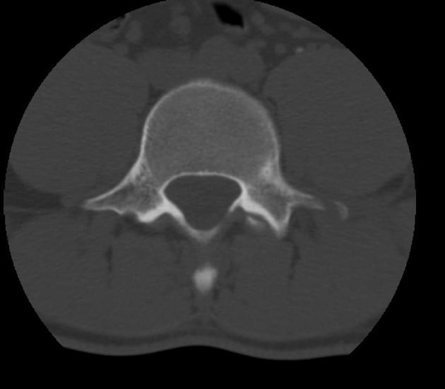 Gãy mỏm ngang (Transverse process fracture)