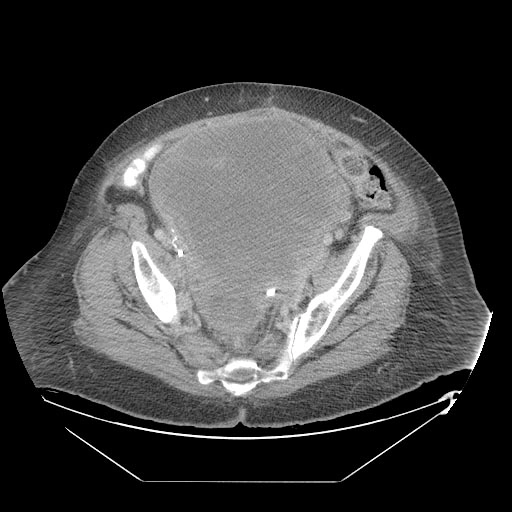 Sarcoma cơ trơn tử cung (Uterine Leiomyosarcoma)
