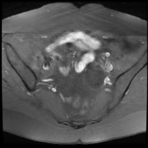 Nang vùi buồng trứng (Serous inclusion cysts of the ovary)