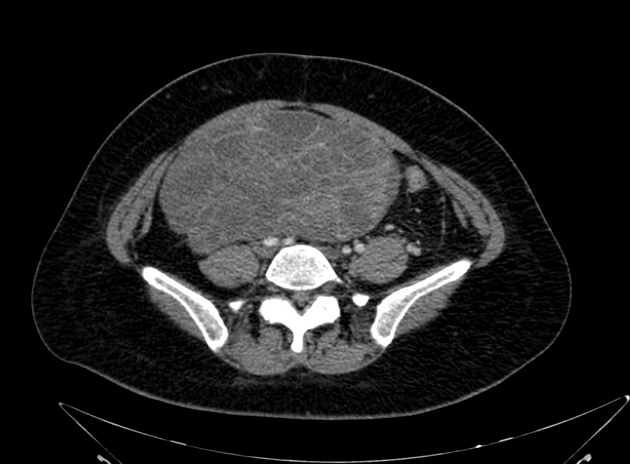 Khối u di căn buồng trứng (Metastases to the ovary)