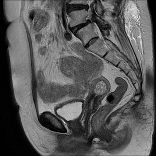 Tăng sản nội mạc tử cung dạng nang (Cystic endometrial hyperplasia)