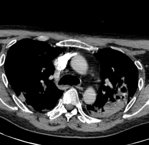 Áp xe sau hầu (Retropharyngeal abscess)
