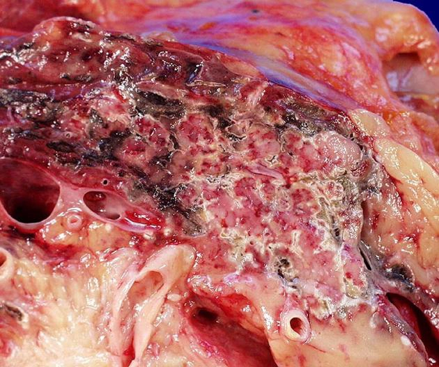 Viêm tụy cấp (Acute Pancreatitis)