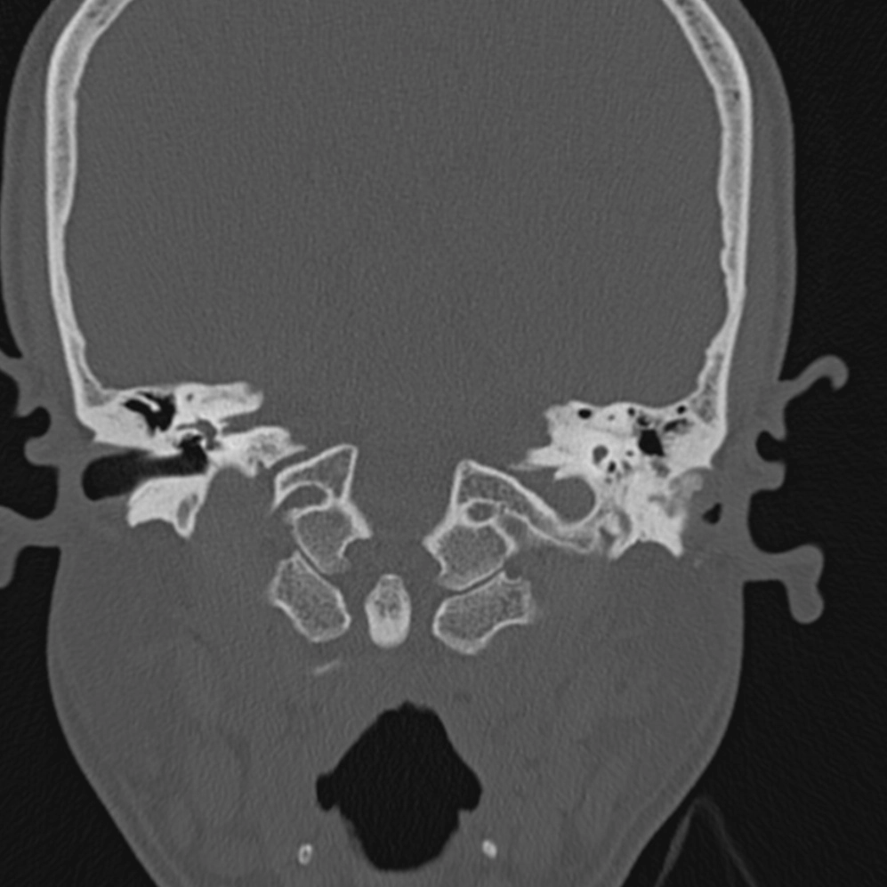 U xương ống tai ngoài (External auditory canal osteomas)