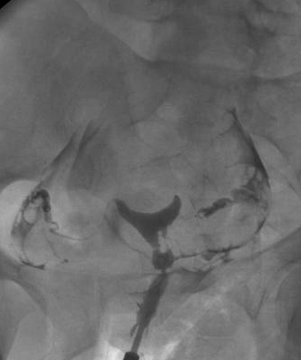 Dính buồng tử cung (Asherman syndrome)