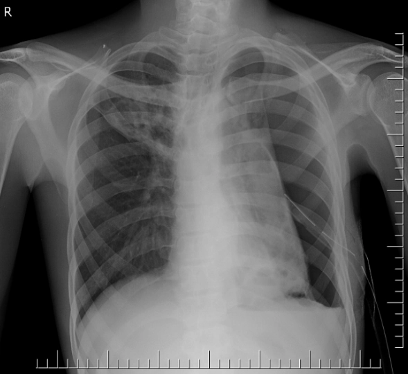 Ống thông liên sườn (Intercostal catheters - ICC)