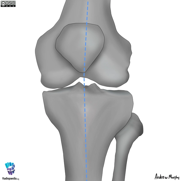 Dập xương ở gối (Patterns of bone bruise in knee injury)