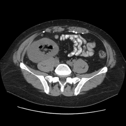 Viêm bể thận sinh hơi (Emphysematous pyelitis)