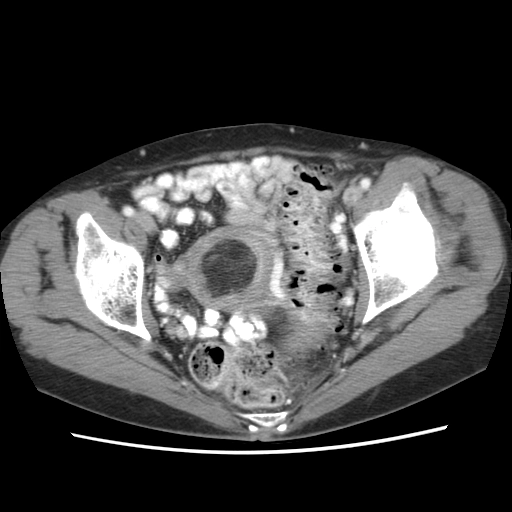 U mỡ cơ trơn tử cung (Uterine lipoleiomyoma)