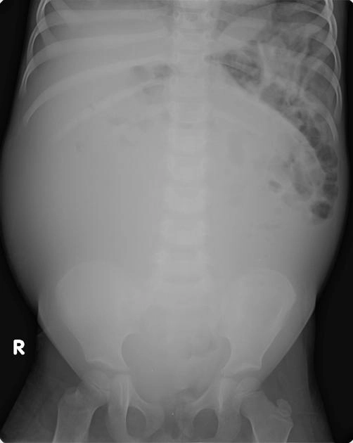 Tổng quan các khối u tế bào mầm của buồng trứng (Germ cell tumors of the ovary)