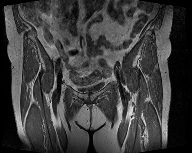 Hội chứng dải chậu-chày ở khớp háng (Proximal iliotibial band syndrome)