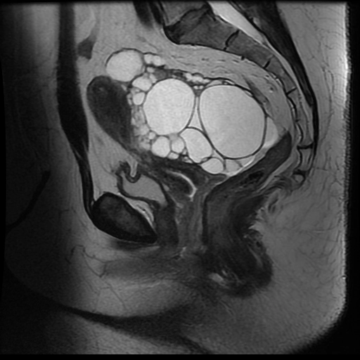 U nang sợi tuyến/ U sợi tuyến buồng trứng (Cystadenofibroma/ Adenofibroma)