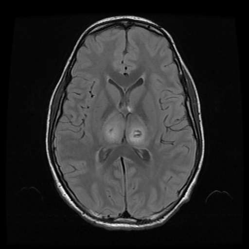 Viêm não do virus Dengue (Dengue encephalitis)