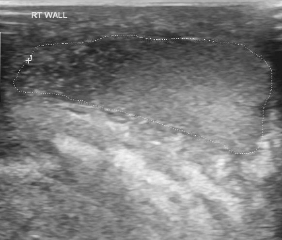 Áp xe thành bìu (Scrotal wall abscess)