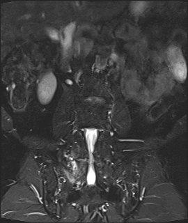 Thoái hóa khớp liên mấu (Facet joint arthropathy)