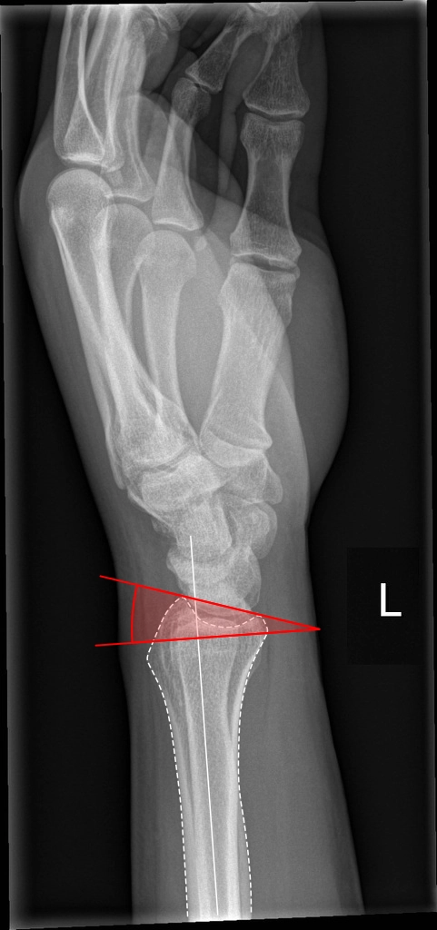 Độ nghiêng lòng tay (Volar tilt)