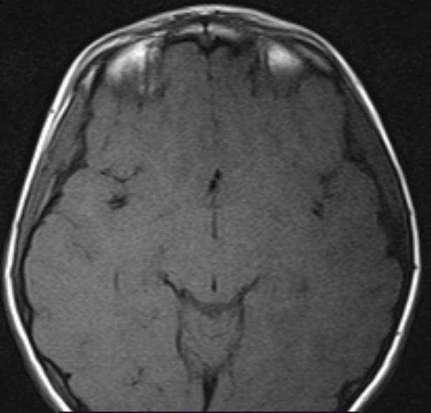 Tồn tại hai tuyến yên (DPG - Duplication of the Pituitary Gland)
