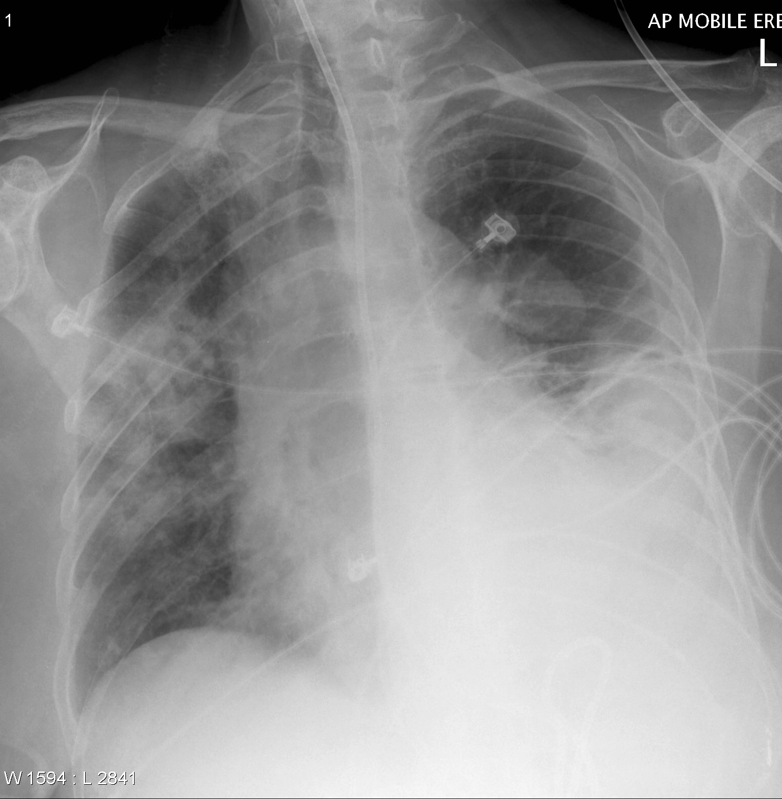Giả u màng phổi (Pleural pseudotumor)