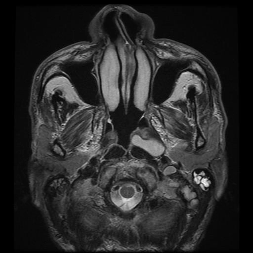 Nang ứ đọng khoang niêm mạc hầu (Retention Cyst of Pharyngeal Mucosal Space)