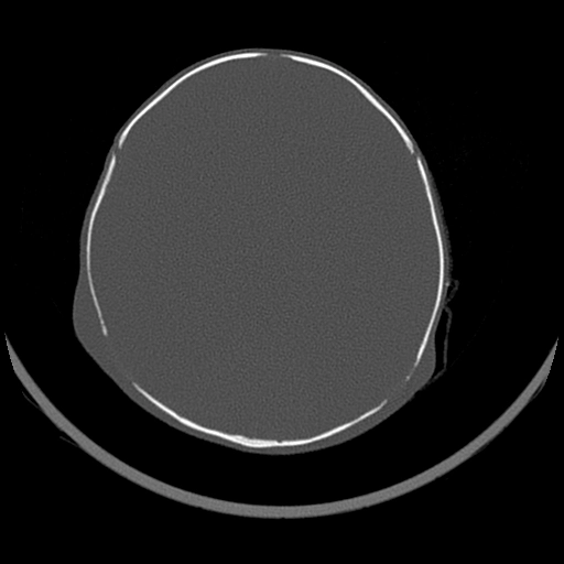 Phù não thẩm thấu (Osmotic Cerebral Edema)
