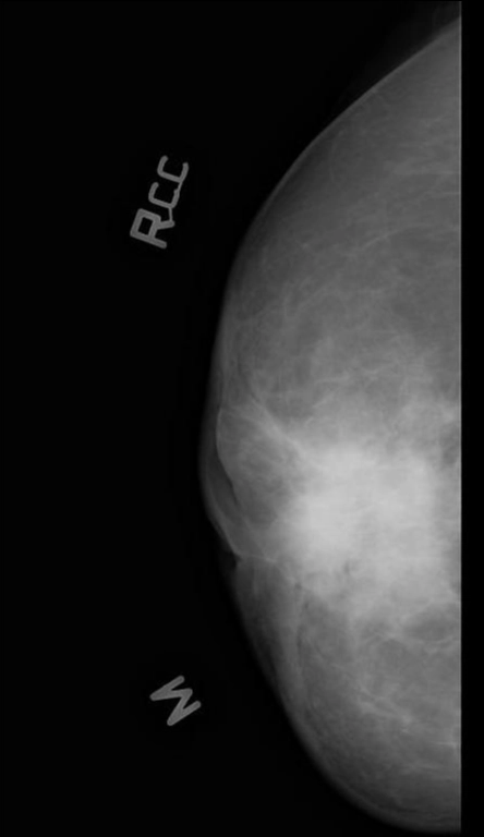 U tân sinh của vú (Breast neoplasms)