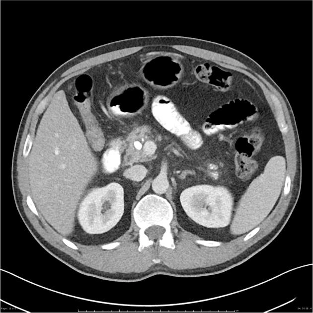 Teo nhu mô tụy (Pancreatic atrophy)