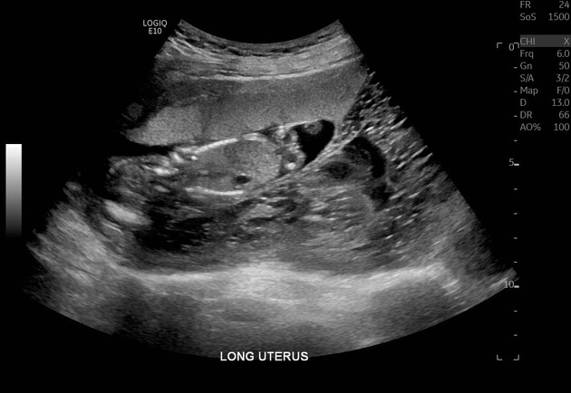 Thai trứng toàn phần đi kèm thai bình thường (Complete hydatidiform mole with coexistent fetus)