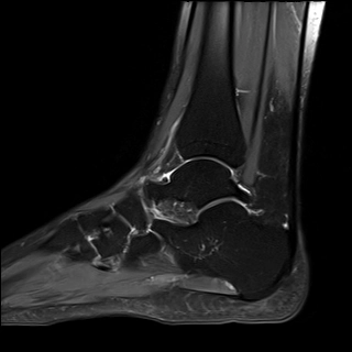 Hội chứng chèn ép trước ngoài cổ chân (Anterolateral ankle impingement)