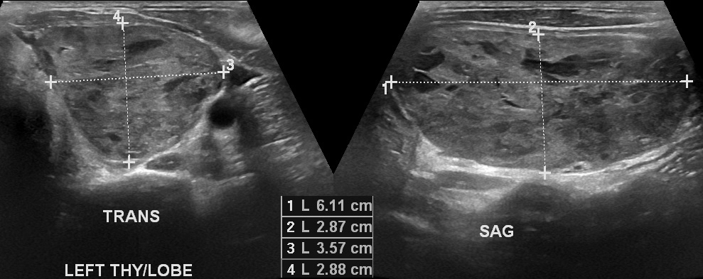 Carcinoma tế bào oncocytic của tuyến giáp (Oncocytic carcinoma of the thyroid gland)
