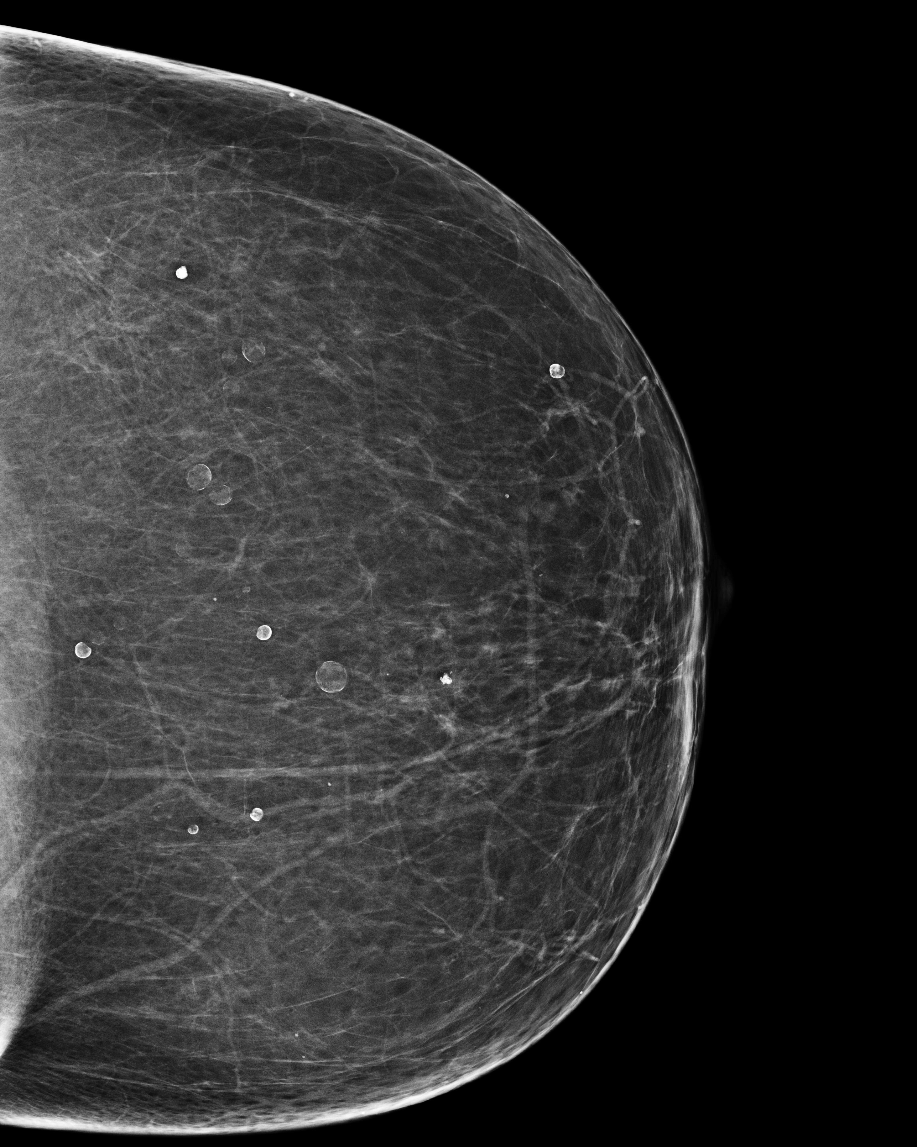 Vôi hóa dạng vỏ trứng (Eggshell calcification (breast))