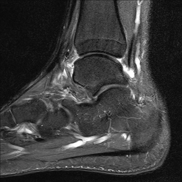 Tổn thương dây chằng sên-mác sau (Posterior Talofibular Ligament - PTFL injuries) 