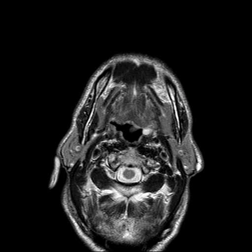 U mỡ vùng cổ (Neck lipoma)