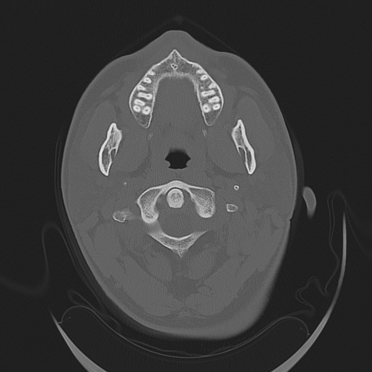 Bệnh mô bào Langerhans nền sọ (Skull Base Langerhans Cell Histiocytosis - LCH)