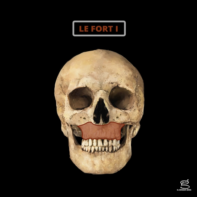 Gãy xương Le Fort (Le Fort fracture classification)