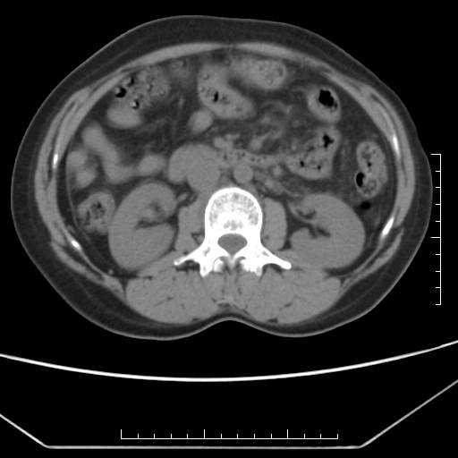 Màng ngăn tĩnh mạch chủ dưới (Inferior Vena Cava - IVC webs)
