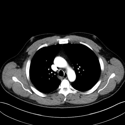 Cavernoma ngoài màng cứng cột sống (Extradural spinal cavernous malformation)