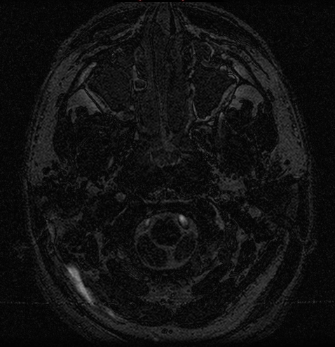 Viêm mê nhĩ cốt hóa (Labyrinthitis ossificans)