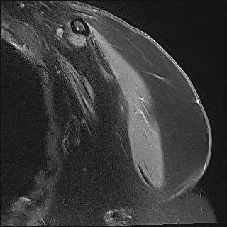 Thoái hóa khớp cùng đòn (Acromioclavicular Joint Osteoarthritis)