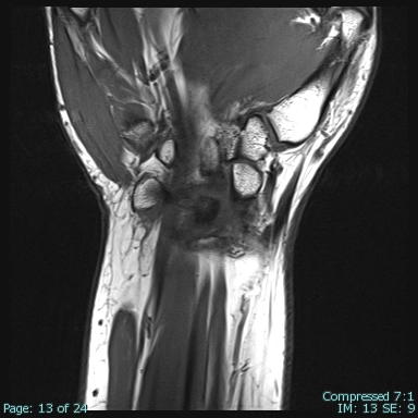 Hội chứng kẹt mỏm trâm trụ (Ulnar styloid impaction syndrome)