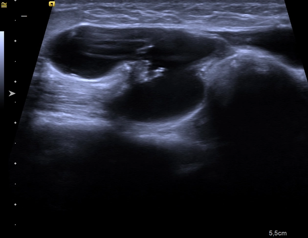 Nang nước ống Nuck (Hydrocele of the canal of Nuck)