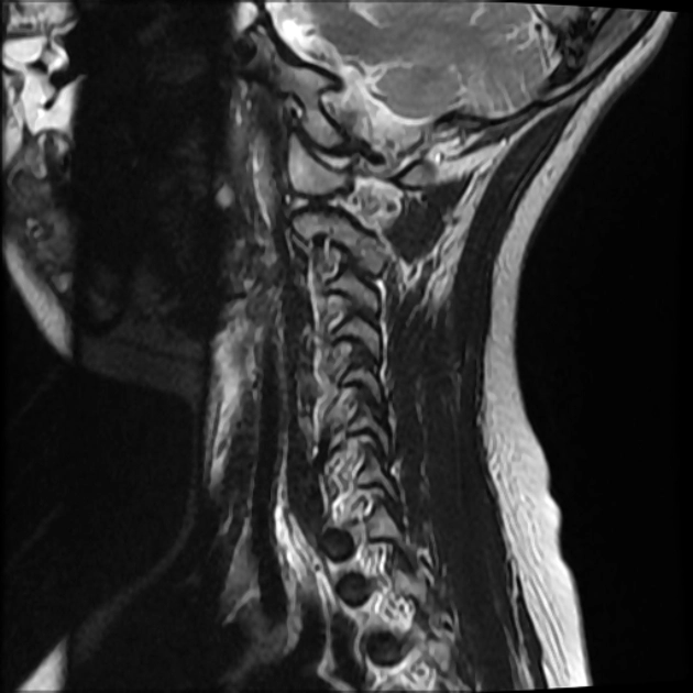 Xoang bì bẩm sinh (Dorsal dermal sinus)