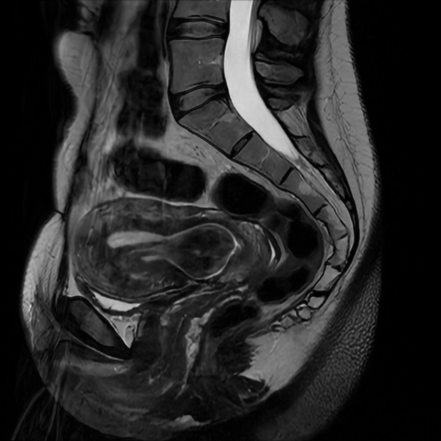 Phân loại FIGO cho u xơ tử cung (FIGO classification system for uterine leiomyoma)