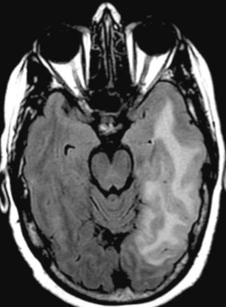 Bệnh lý viêm vi mạch não dạng bột (Cerebral Amyloid Angiopathy-Related Inflammation- CAA-RI )